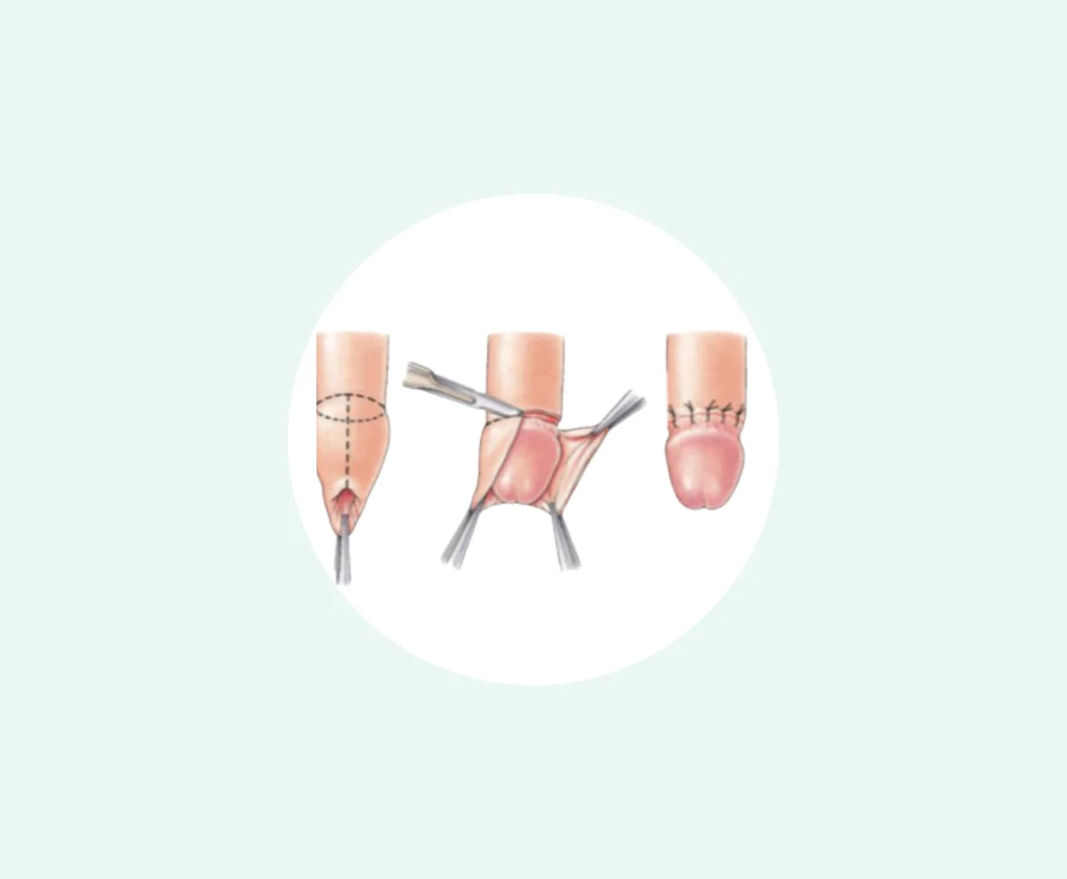 Laser Stapler Circumcision Services